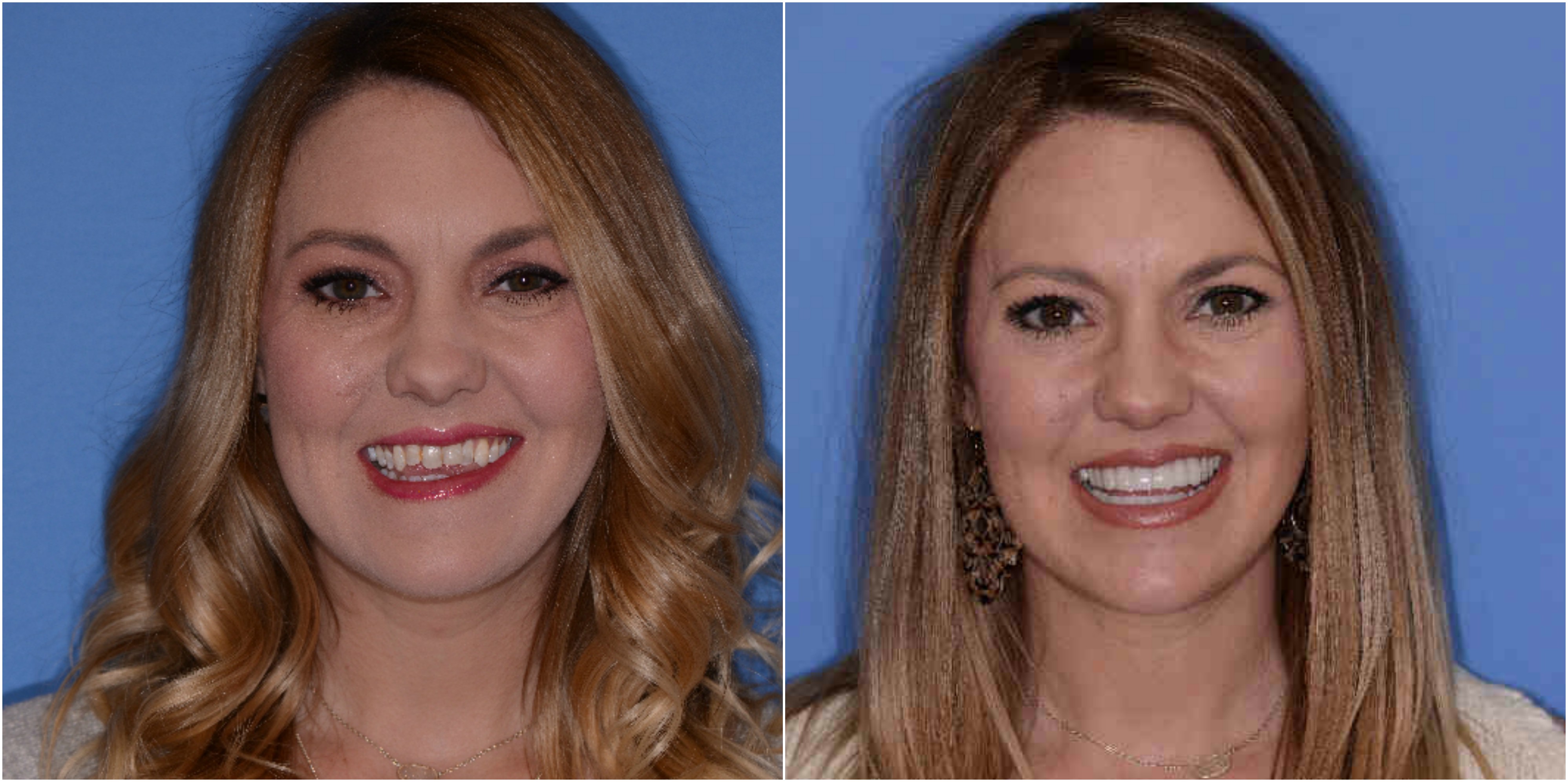 Before & After Gallery Dentist in Amarillo, TX